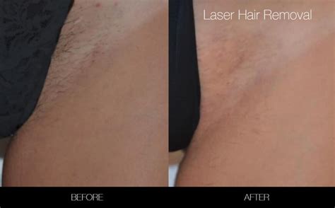 full brazilian hair removal pictures
